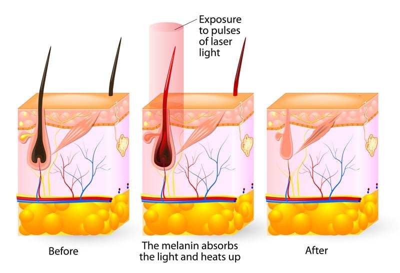 Laser hair removal for blonde hair on the face - wide 1