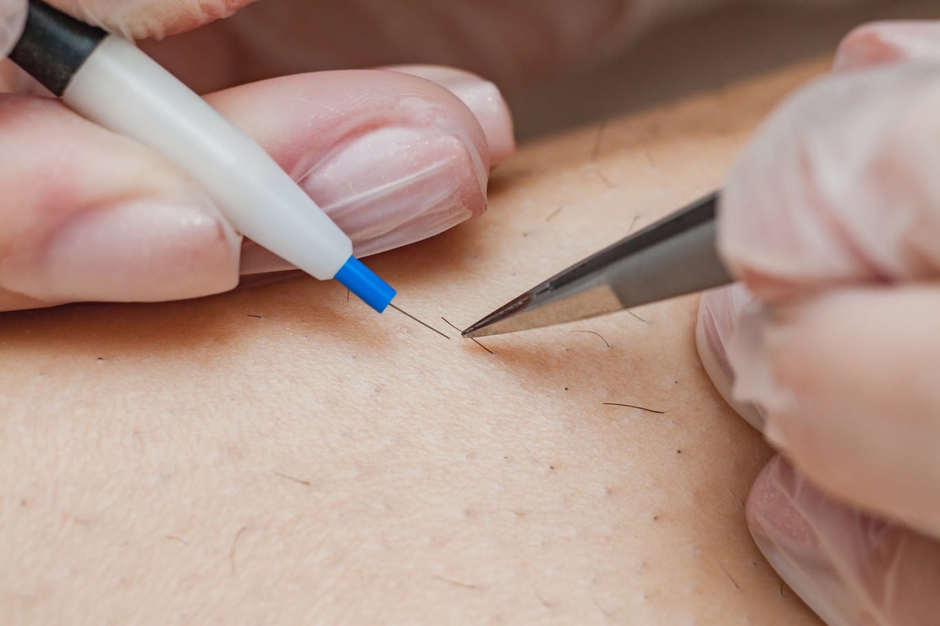Electrolysis vs. Laser Hair Removal The Best Options for You LivSmooth
